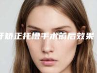 牙矫正托槽手术前后效果对比图