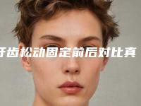 牙齿松动固定前后对比真实效果