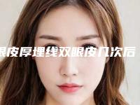 眼皮厚埋线双眼皮几次后永久