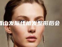 眉山发际线植发整形后会不会留下后遗症