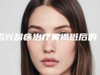 绍兴刮痧治疗黄褐斑后的调养和治疗方法