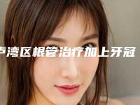 卢湾区根管治疗加上牙冠价目表医生免费咨询-卢湾区根管治疗加上牙冠价格