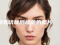副乳切除后痊愈的图片 告别尴尬,终于可以穿可爱小吊带啦!