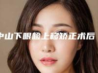 中山下眼睑上移矫正术后会有后遗症吗