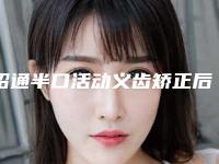 昭通半口活动义齿矫正后的护理