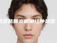 武汉结膜炎眼角红肿是否会影响健康