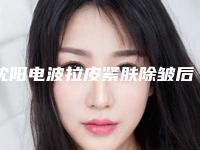 沈阳电波拉皮紧肤除皱后遗症表现是什么