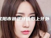 沈阳市矫正牙齿后上牙外凸医院上榜清单top10最新(沈阳市矫正牙齿后上牙外凸口腔医院你一定要了解)