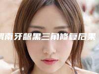 渭南牙龈黑三角修复后果会怎么样