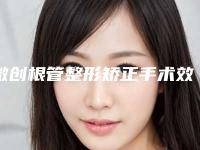 微创根管整形矫正手术效果怎样