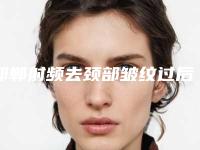 邯郸射频去颈部皱纹过后该如何保养