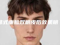 韩式重脸双眼皮后效果明显吗 制作光亮美眼