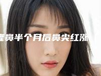 隆鼻半个月后鼻尖红涨(隆鼻半个月后鼻尖红涨怎么办)