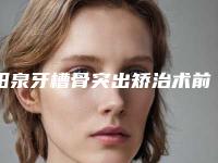 阳泉牙槽骨突出矫治术前准备及手术副作用