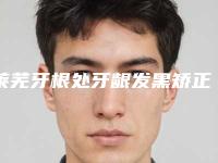 莱芜牙根处牙龈发黑矫正的手术步骤及术后护理