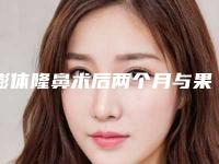 膨体隆鼻术后两个月与果图对比图分享，终于成为高鼻梁