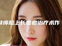 蚌埠脸上长痘痘治疗术作用能维持多长时间