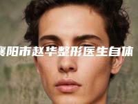 襄阳市赵华整形医生自体丰脸部手术具体价格