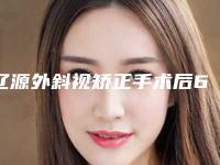 辽源外斜视矫正手术后6个护理要点