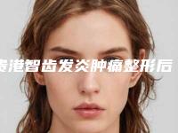 贵港智齿发炎肿痛整形后遗症主要有哪些