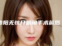 贵阳无忧开眼角手术前后效果明显吗?