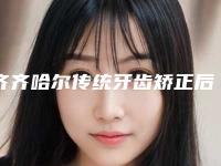 齐齐哈尔传统牙齿矫正后可以保持多长时间