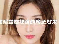 黑脸娃娃祛痘的矫正效果-黑脸娃娃祛痘效果的几大因素