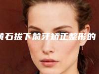 黄石拔下前牙矫正整形的禁忌人群及要求