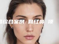 鼻综合案例 网红鼻 项目分类：鼻部整形 鼻部综合