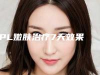 IPL嫩肤治疗7天效果恢复图「IPL嫩肤治疗效果真的有这么好吗」